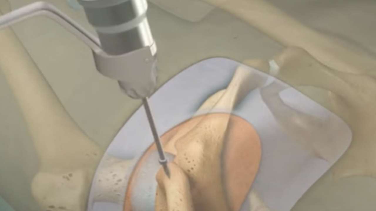 Medimetrix-BoneMarrow Procedure