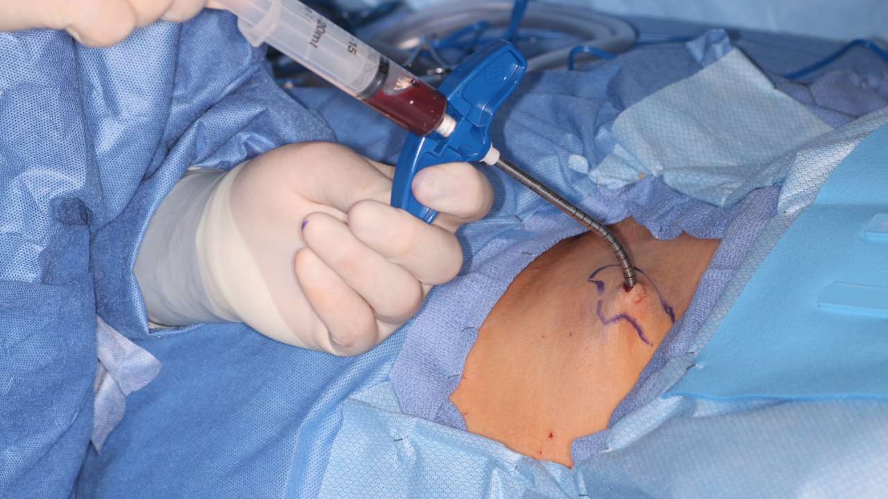 Medimetrix-MarxMan showing the bend and flexibility Team of surgeons is fighting for life. The doctor is undergoing surgery to save a life from an accid
